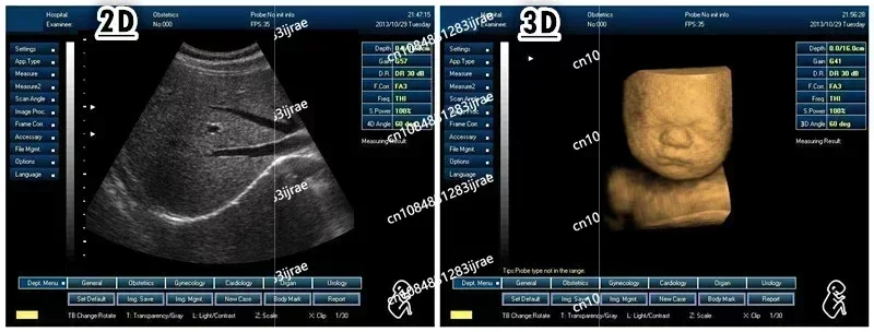 Portable 3d Ultrasound Machine Medical Scan Digital Pseudo Color Usg 4d Optional Ecography