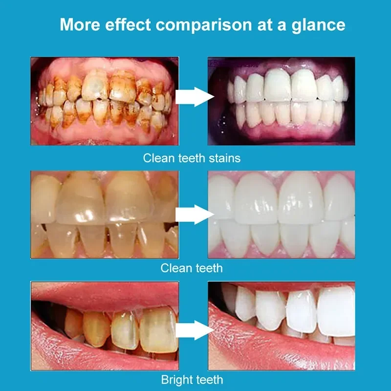 Dentifrice blanchissant pour les dents, dissolvant de tartre dentaire, dissolvant de plaque dentaire, haleine fraîche, éclaircissement, prévention de la parodontite, soins dentaires