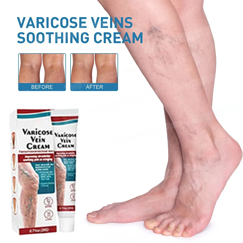 

Vein repair cream reduces varicose veins, promotes blood circulation and vasoconstriction essence of leg care 2024