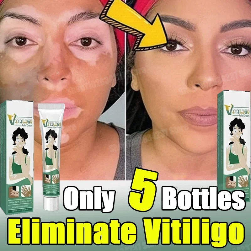 

Vitiligo Removal Cream White Spot Care Cream Skincare cream vitiligo skin Sweat spot Reduce white spots Skin care