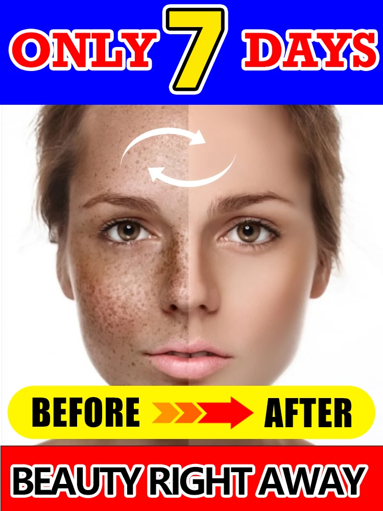 Nuova potente crema sbiancante, illumina rapidamente il tono della pelle, elimina la melanina, le macchie scure