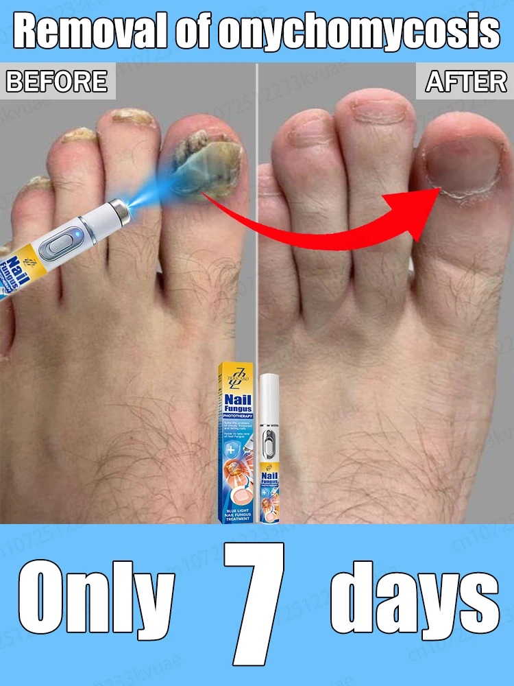 

Say goodbye to onychomycosis with scientific methods, safe and without recurrence