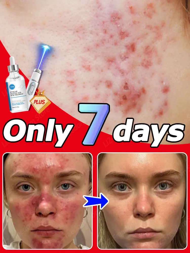 

Acne Treatment Cream For Face Scar Serum Remedy