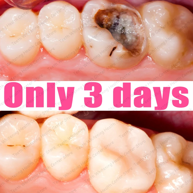 

Чистка гнеких зубов и восстановление полости рта.