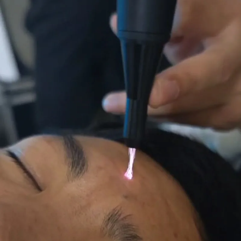 Portable 2 in 1 Cold Plasma Eyelid Lifter Effective Painless Minimally Invasive For Wrinkle Removal Skin Rejuvenation Machine image 6