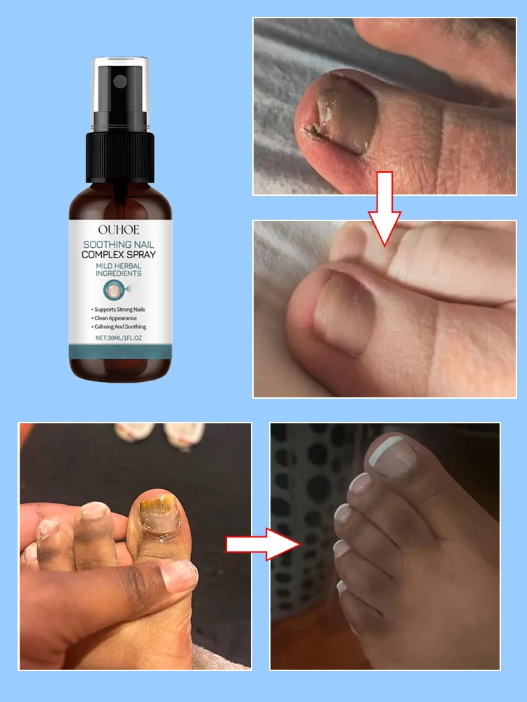 Óleo essencial para tratamento de fungos nas unhasrepara onicomicose em 7 dias