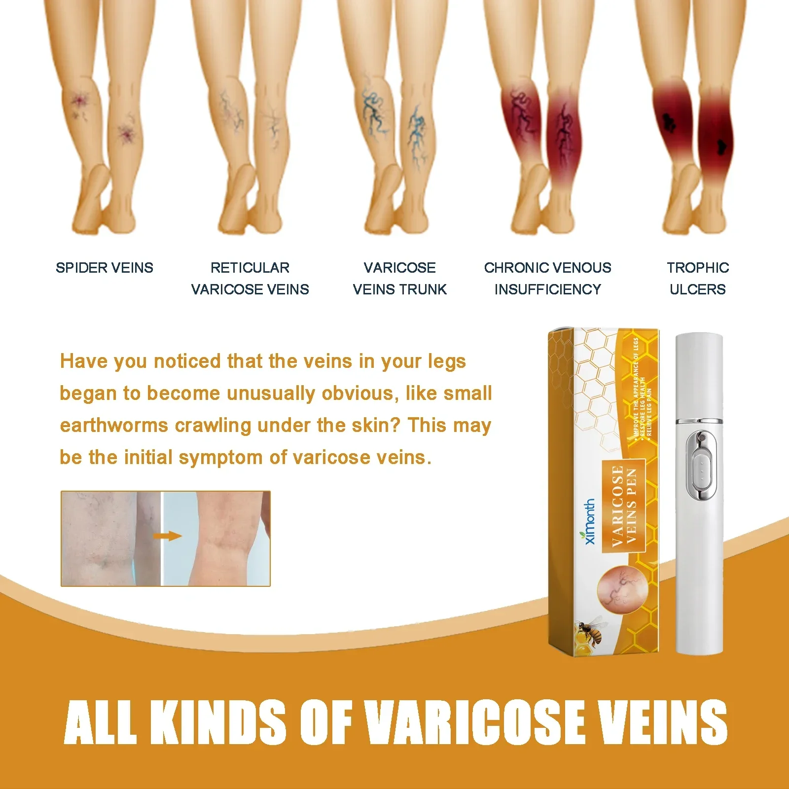 Lampshade Therapy Leg Repair Pen Relieves Leg Bulge Discomfort Improving Blood Circulation Varicose Veins Pen Skin Care Product