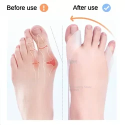 علاج الاسترخاء Foot Care Tools Big Toe Hallux Valgus Corrector Orthotics Feet Care Bone Thumb Adjuster Correction Belt