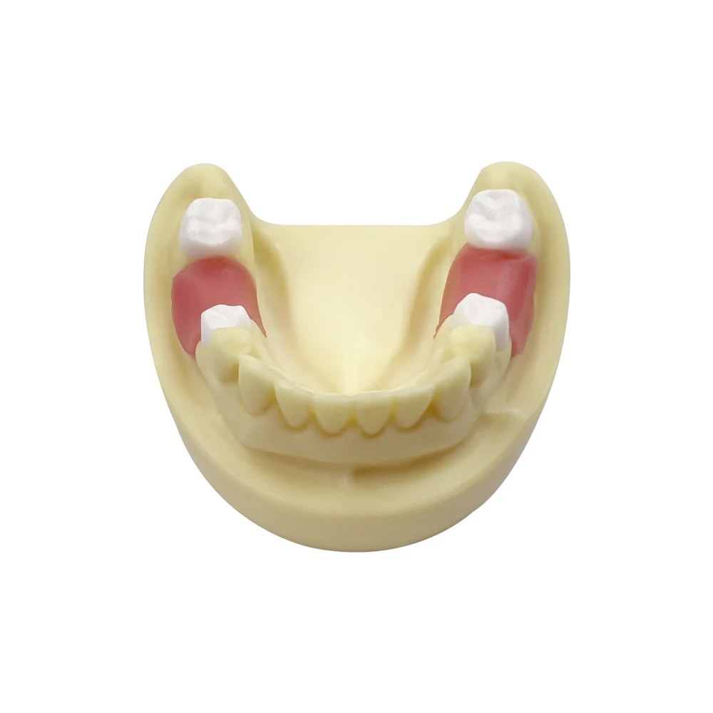 Dental Teeth Implant Practice Model Mandibular Missing Teeth Implant Teaching Model For Dentist Technician Studying Training