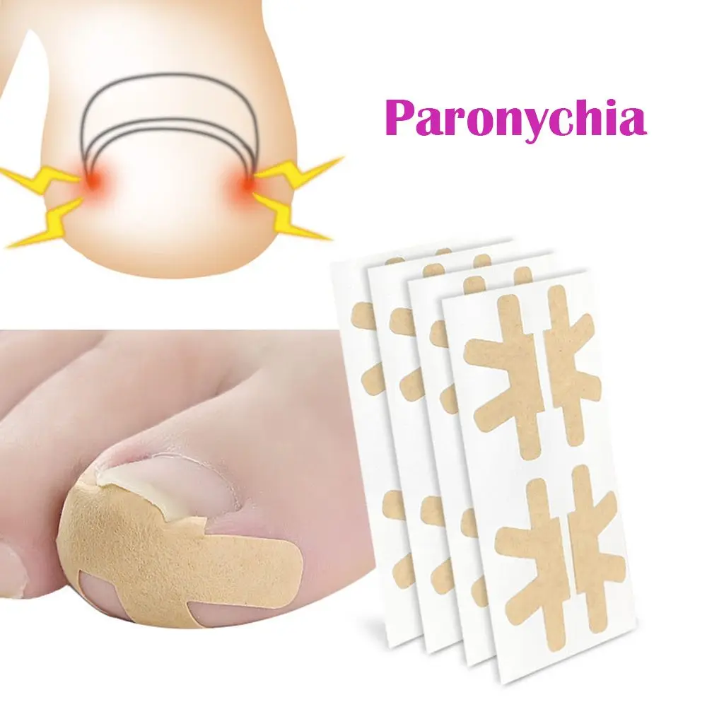 Paronychia Treatment Fixer Nail Care Patch Pedicure Tools Toenail Treatment Corrector Stickers adesivi per unghie incarnite