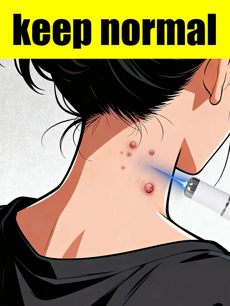 

Laser pointer tool fights off various warts at their source