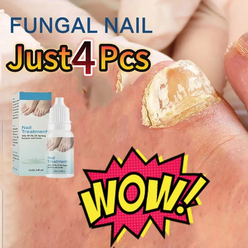 Fungal Nail Removal 10ML Fungal Nail Treatment Oil Foot Repair Essence Toe Nail Fungus Removal Gel Anti Infection Cream