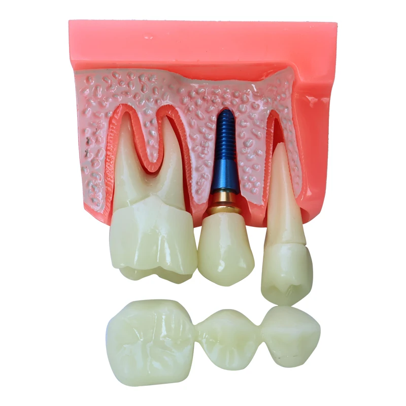 Dental 4x Implant Model, Removable Denture Restoration Implant Model, Used for Teaching Practice and Doctor-Patient Communicatio