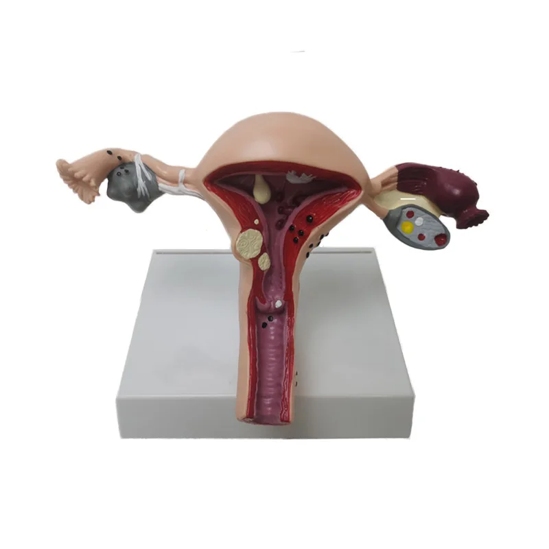 Medical Human Pathological Uterine And Ovarian Anatomical Model Gynecological Display Medical Teaching Supplies