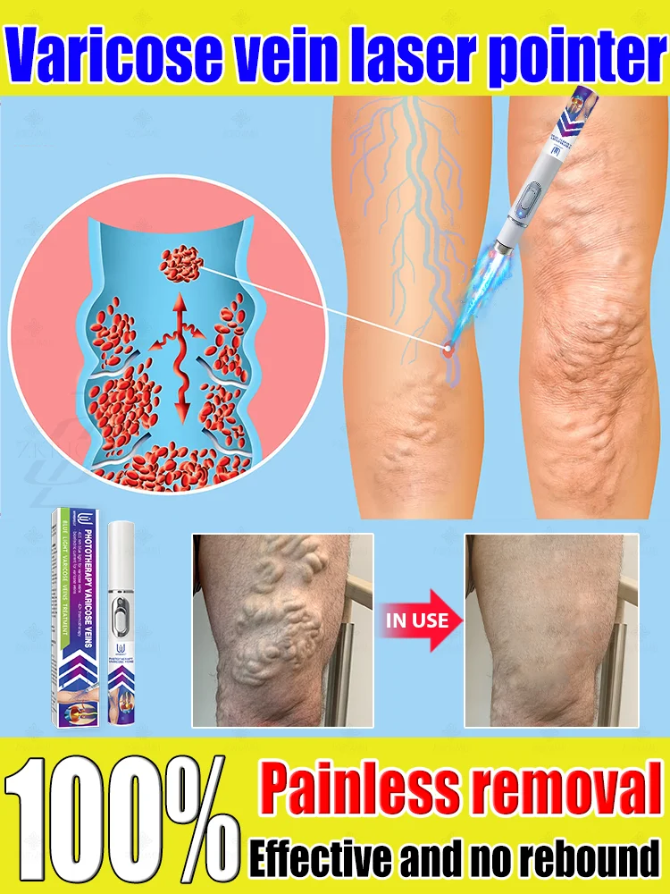 

Reverse leg health in 7 days and say goodbye to varicose vein recurrence