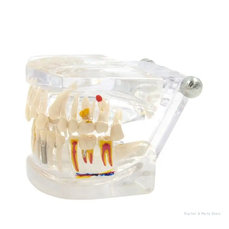 

M17F Clear Dental Implant Teeth Model with Removable Teeth for Dentist Office Patient Communication Medical Lecture Use