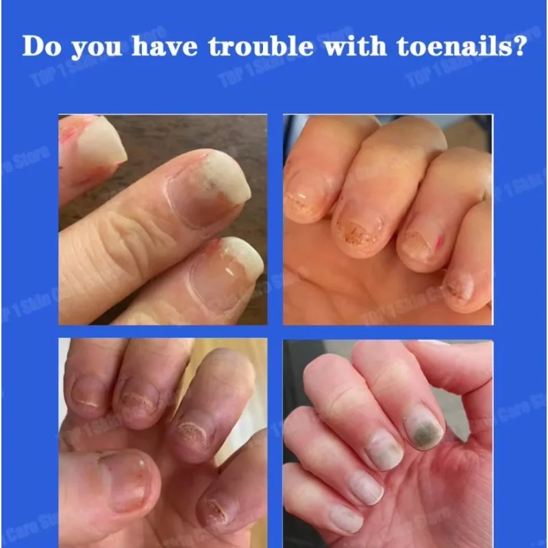 Huile de champignon des ongles, adoucit l'huile de traitement des ongles pour les ongles fragiles et fendus, produit de haute qualité