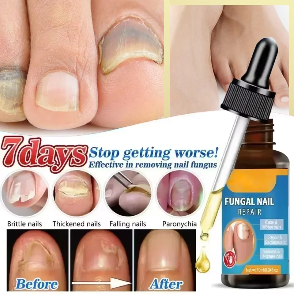 Fungal Nail Treatment Oil Foot Repair Essence Toe Nail Fungus Removal Gel Anti Infection Cream Fungal Nail Removal Paronychia