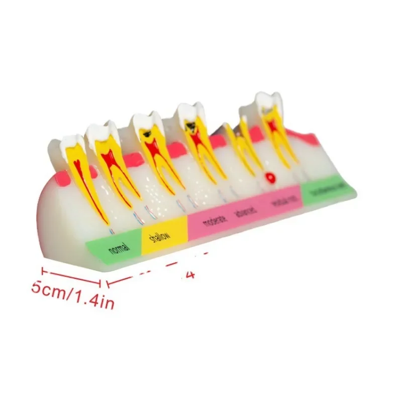 Dental Caries Classification Dental Teaching Model Dental Model Real Material Full Color