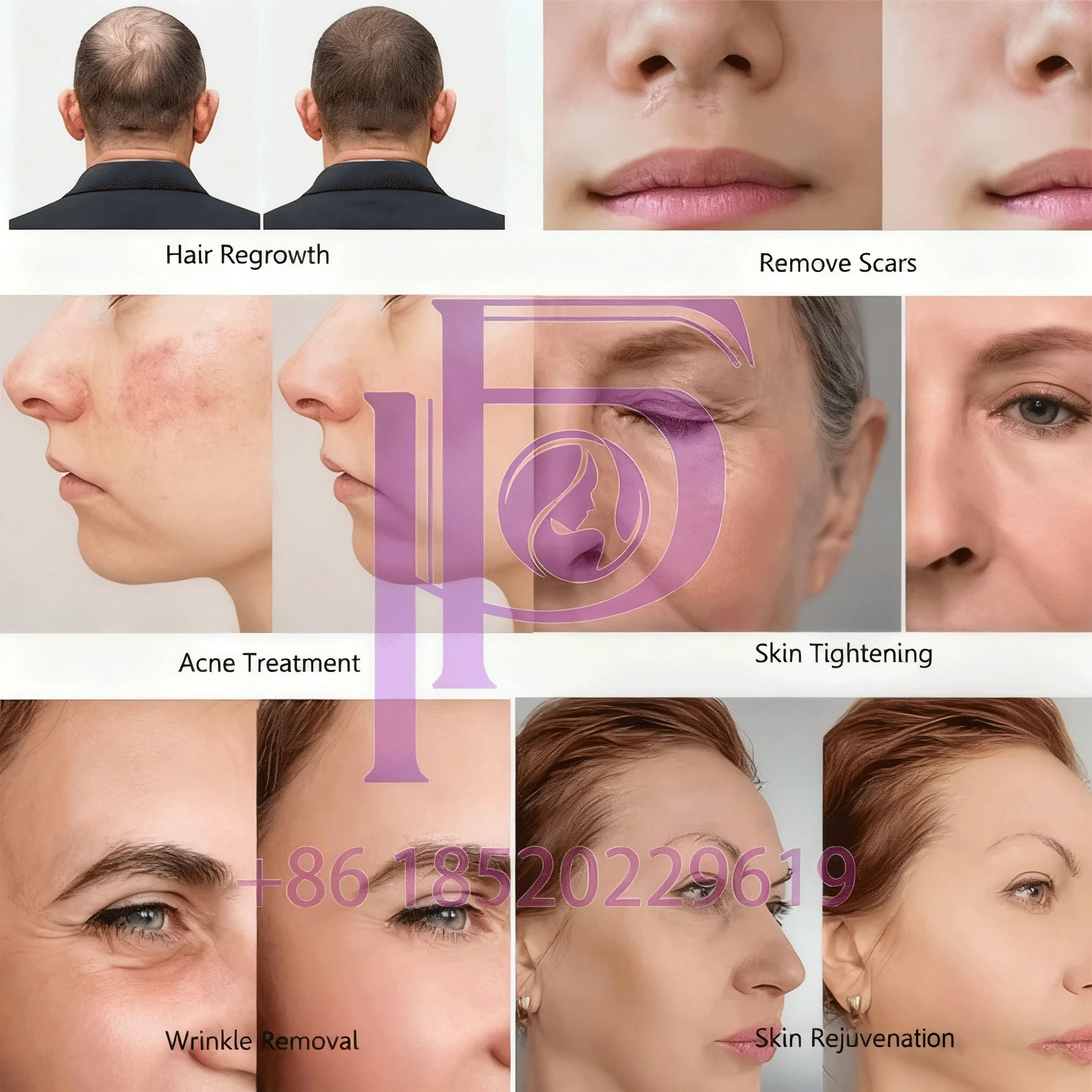 เครื่องพลาสมาบำรุงผิวระดับมืออาชีพ - ได้รับมาตรฐาน CE สำหรับการดูแลสิว/ริ้วรอย ระบบทำความเย็นด้วยน้ำแข็ง สำหรับร้านเสริมสวยและใช้ในบ้าน