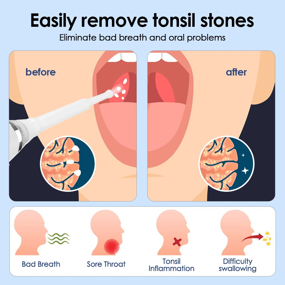 Electronic Tonsil Stone Remover LED Light Vacuum Removal Kit With Irrigation Syringe Oral Care Tonsil Stone Instant Suction Tool