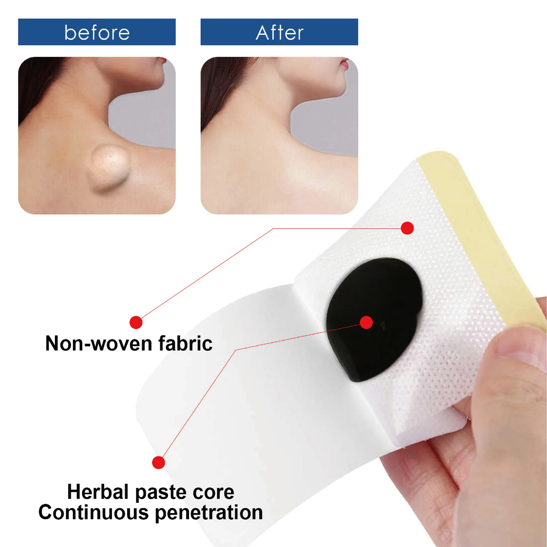 BUPY Patch per la riparazione del nodo grasso lenisce i grumi sottocutanei Patch per la cura della dissoluzione del nodo grasso