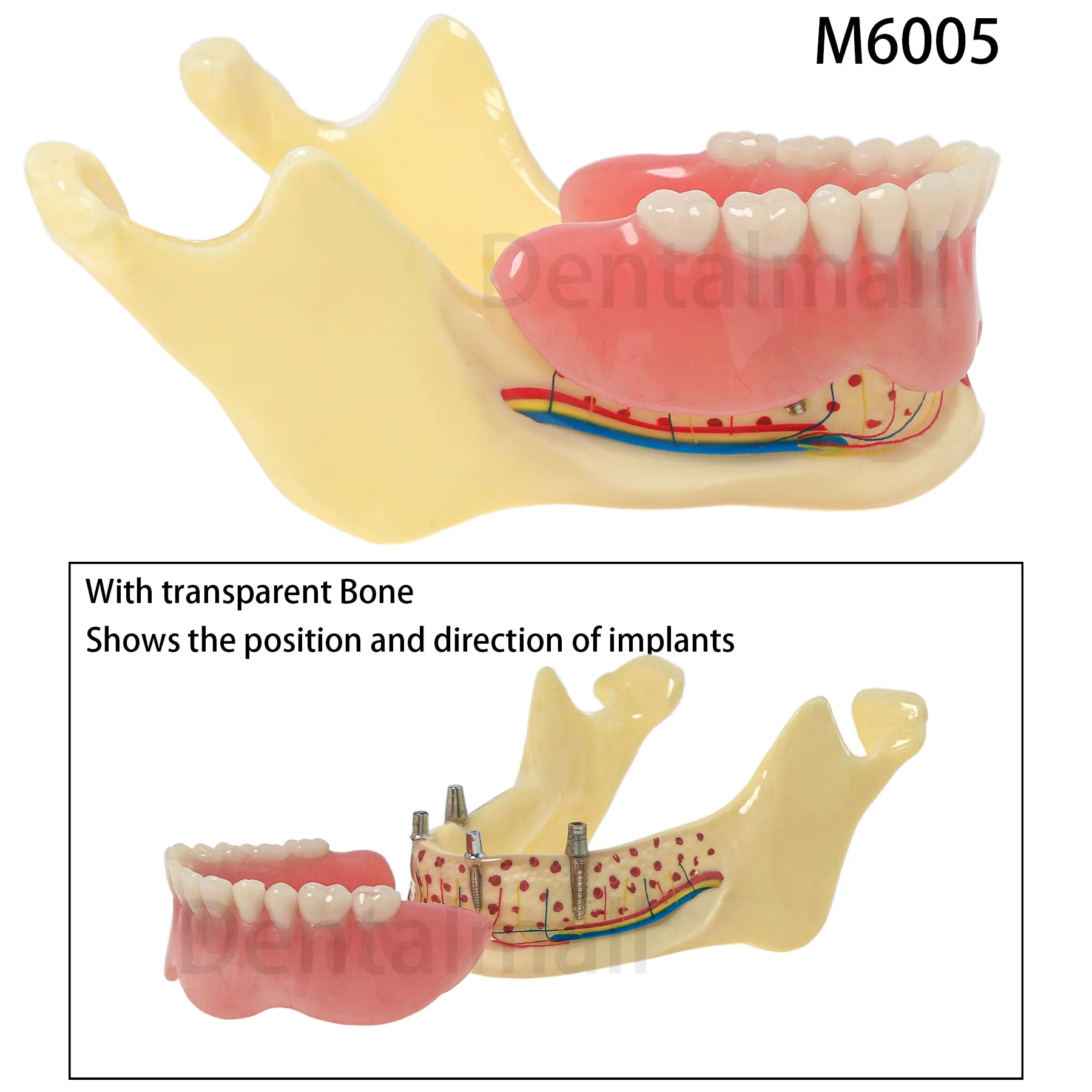 

Dental Implant Teeth Model Overdenture Jaw Typodont Model Transparent Bone Implant Positions M6005