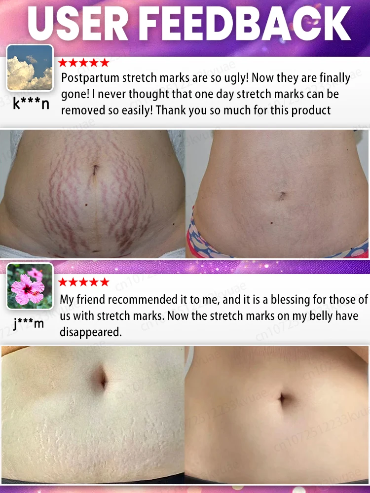 Entfernen Sie Dehnungsstreifen, berechnen Sie Streifen vor, beseitigen Sie sich, beseitigen Sie keine Narben in nur 7 Tagen