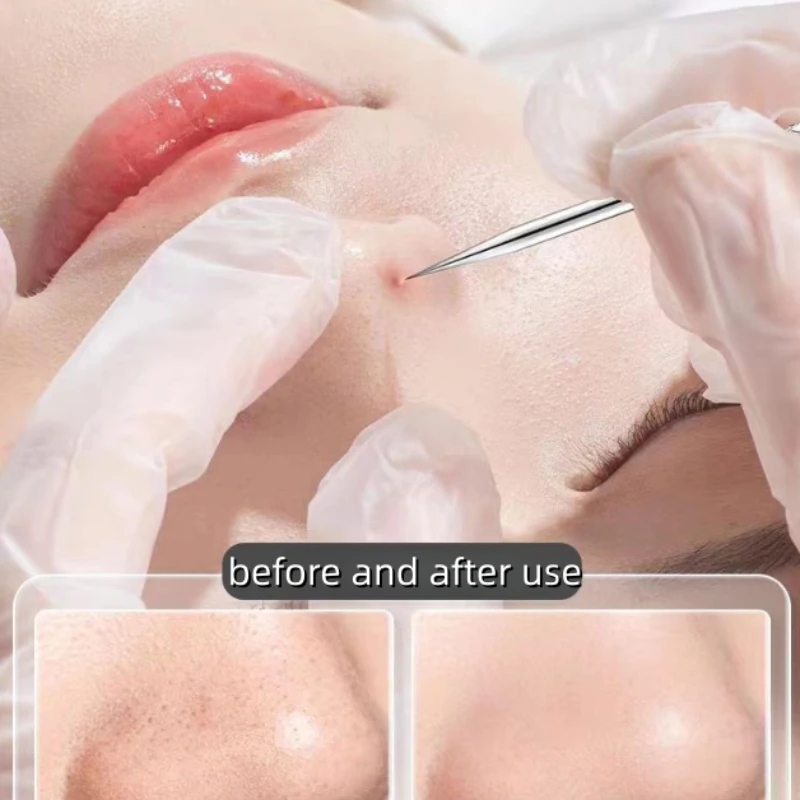 4-11 pz Strumenti per la cura della pelle del viso Acne Rimozione di punti neri Aghi Pinzette per capelli incarniti Punti neri Cleaner Detergente per pori Pulizia profonda