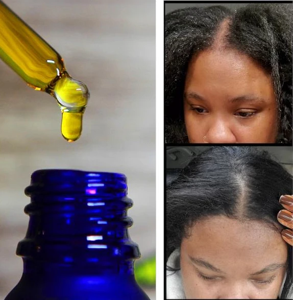 31 Ingredient Rosemary Growth Oil Follicle Activating/ Stimulating DHT Blocking with LUXE FORMULA Stronger than Rogaine