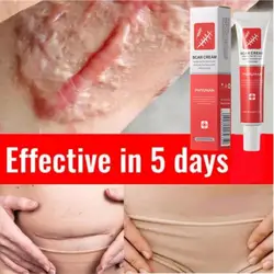 Powerful Scar Removal Cream Healing Old Deep Keloid Scars Treat Stretch Marks Burn Surgical Acne Spot Repair Whitening Skin Care