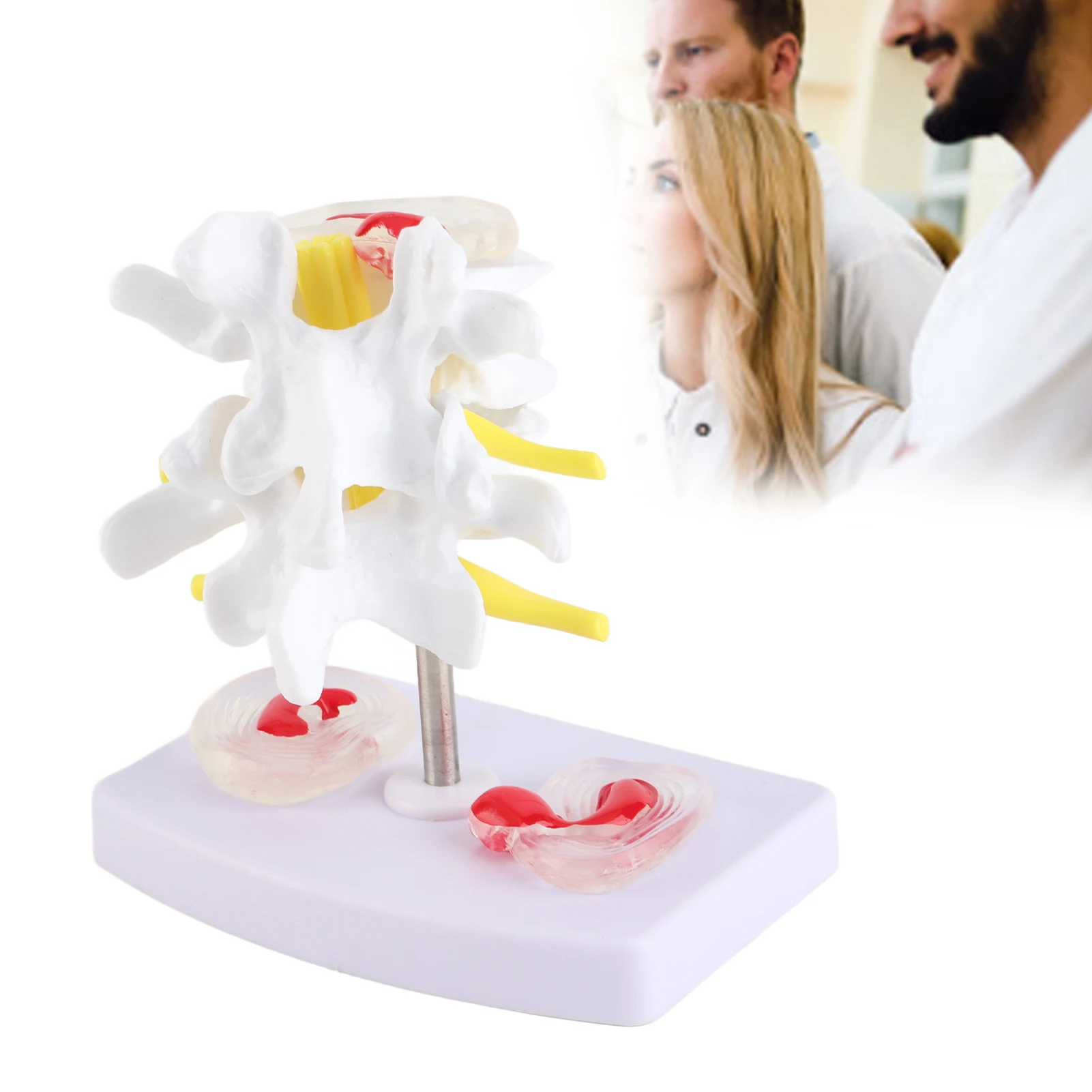 Human Spine Model Anatomical Lumbar Disc Herniation Demonstration Model Human Spine School Training Supplies Teaching Instrument