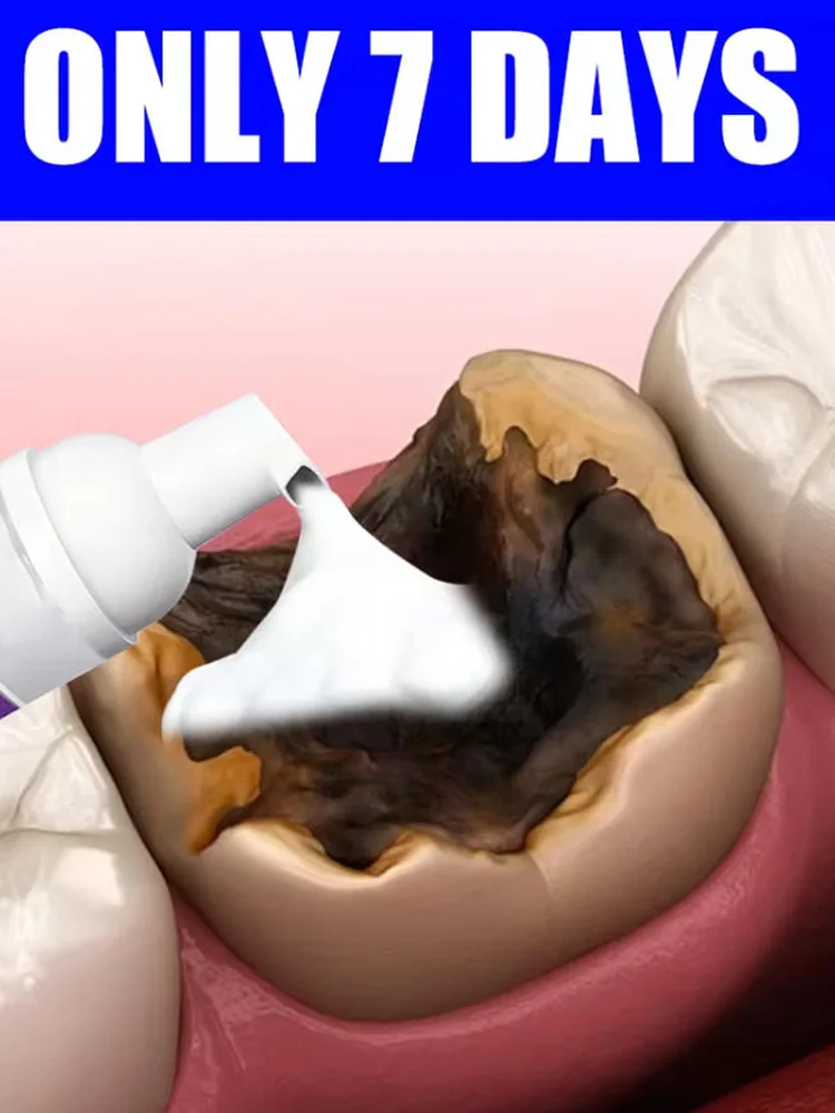 Tooth decay Repair Repairing Cavities Protecting Anti Caries