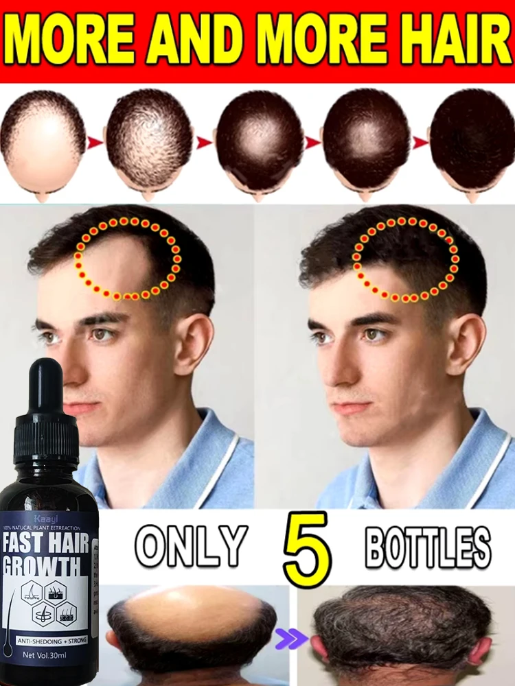 

【have more and more hair】Hot selling product, 99% of buyers buy again, say goodbye to baldness, , thick hair