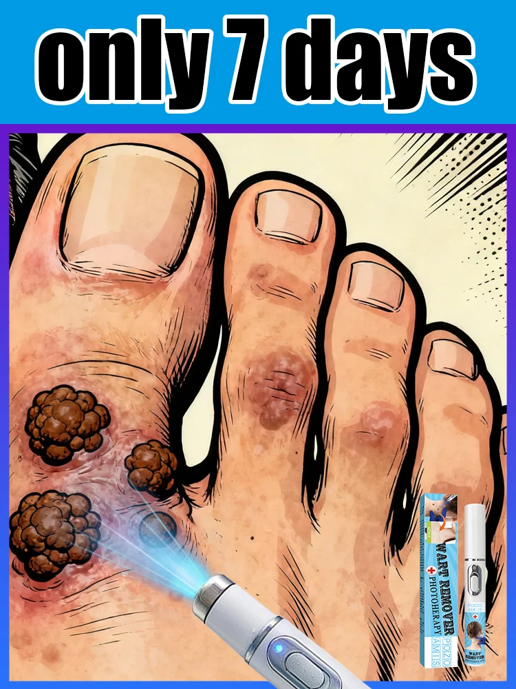 

Generation-3 Laser Says Goodbye To Warts In 7 Days