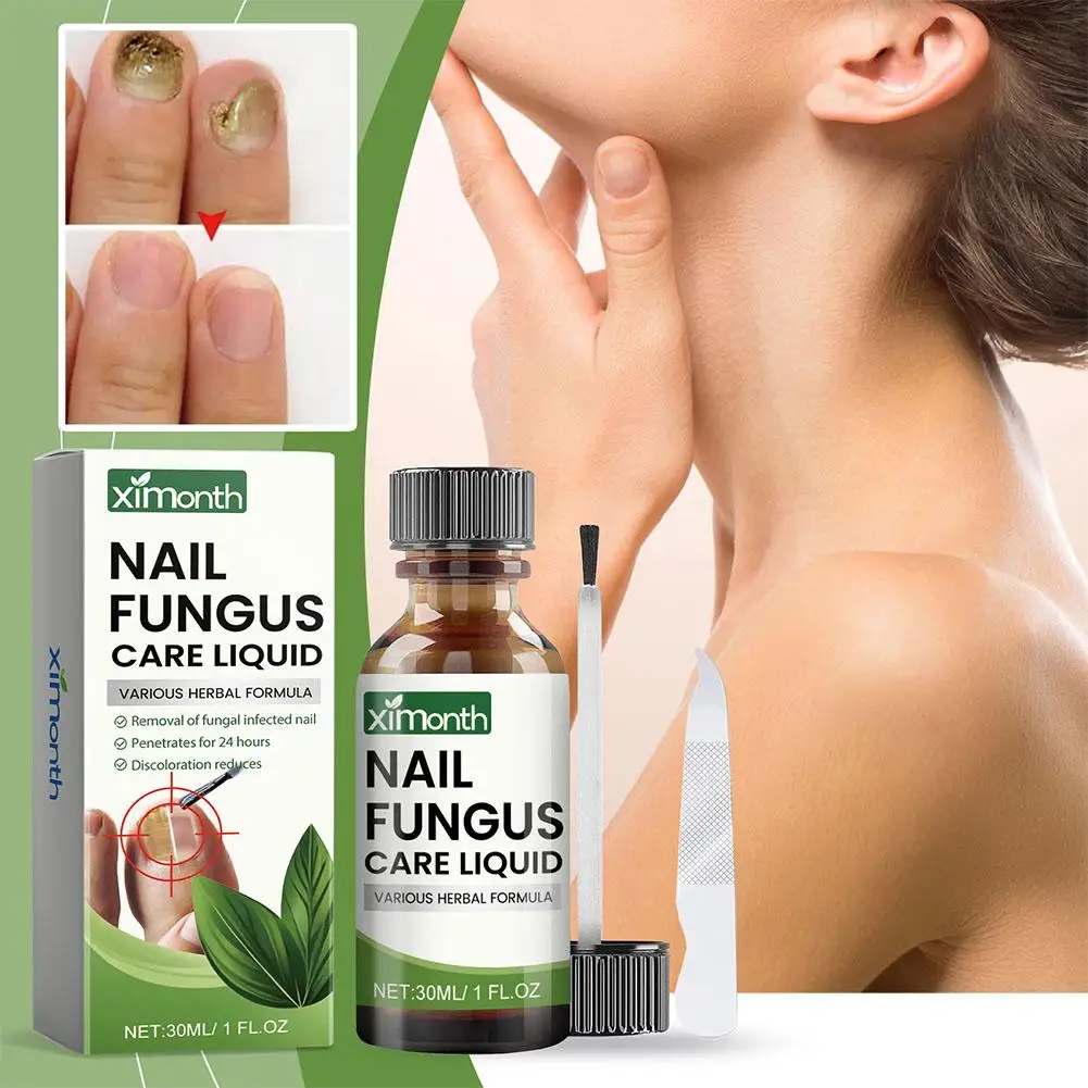 30ml Nail Treatment Solution Toenails Fungal Treatment Repair Liquid Fungus Care Healthy Nail Deep Onychomycosis Cleaning