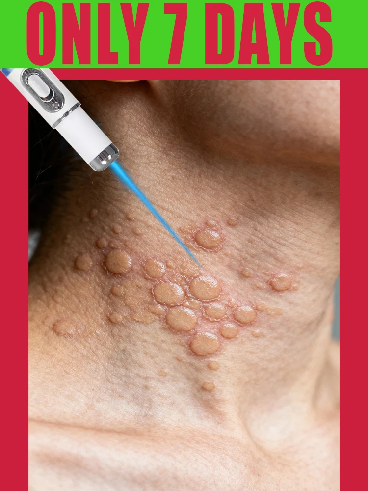 

wart laser pen only few day dealwith gentlely say goodbye with wart anfd spot