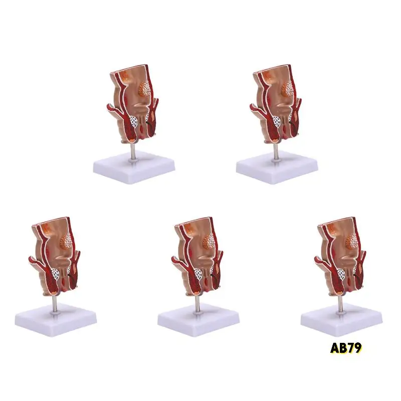 

5X Anatomy Model Human Rectal Hemorrhoid Lesion Model Hemorrhoid Fistula Fistula Fissure Pathology Teaching Model