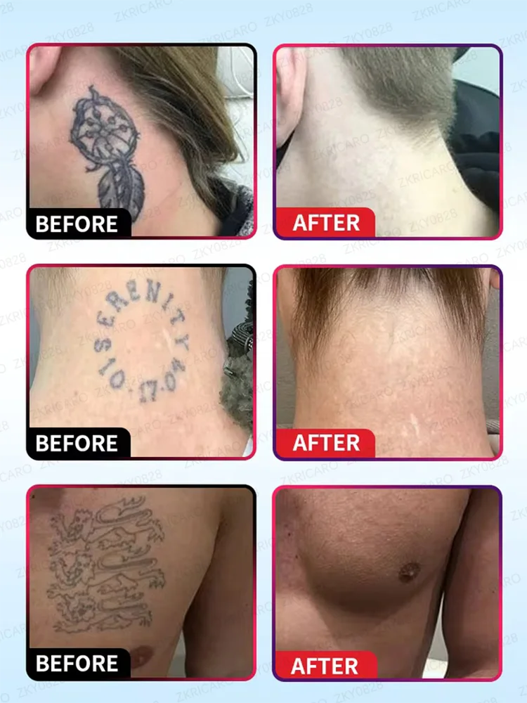 كريم إزالة الوشم السريع يخفف إزالة الوشم بشكل دائم