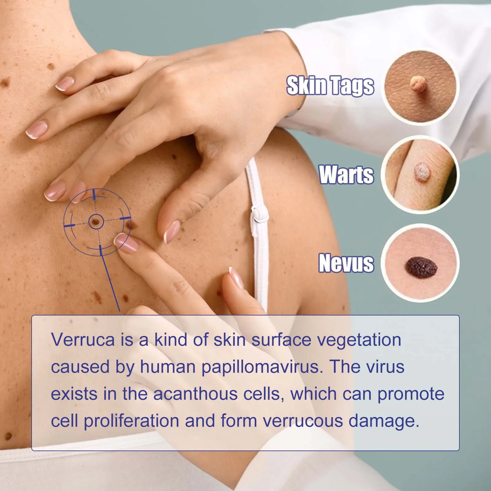 2 in1 무통증 피부 태그 점 제거 키트 클리닝 도구 얼굴 피부 관리 바디 점 치료 제거기 뷰티 헬스