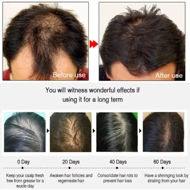 Hair Growth Serum 7 Days Fast Regrowth Essential Capsule Anti Hair Loss Baldness Repair Damaged Scalp Treatment For Women Men view 4