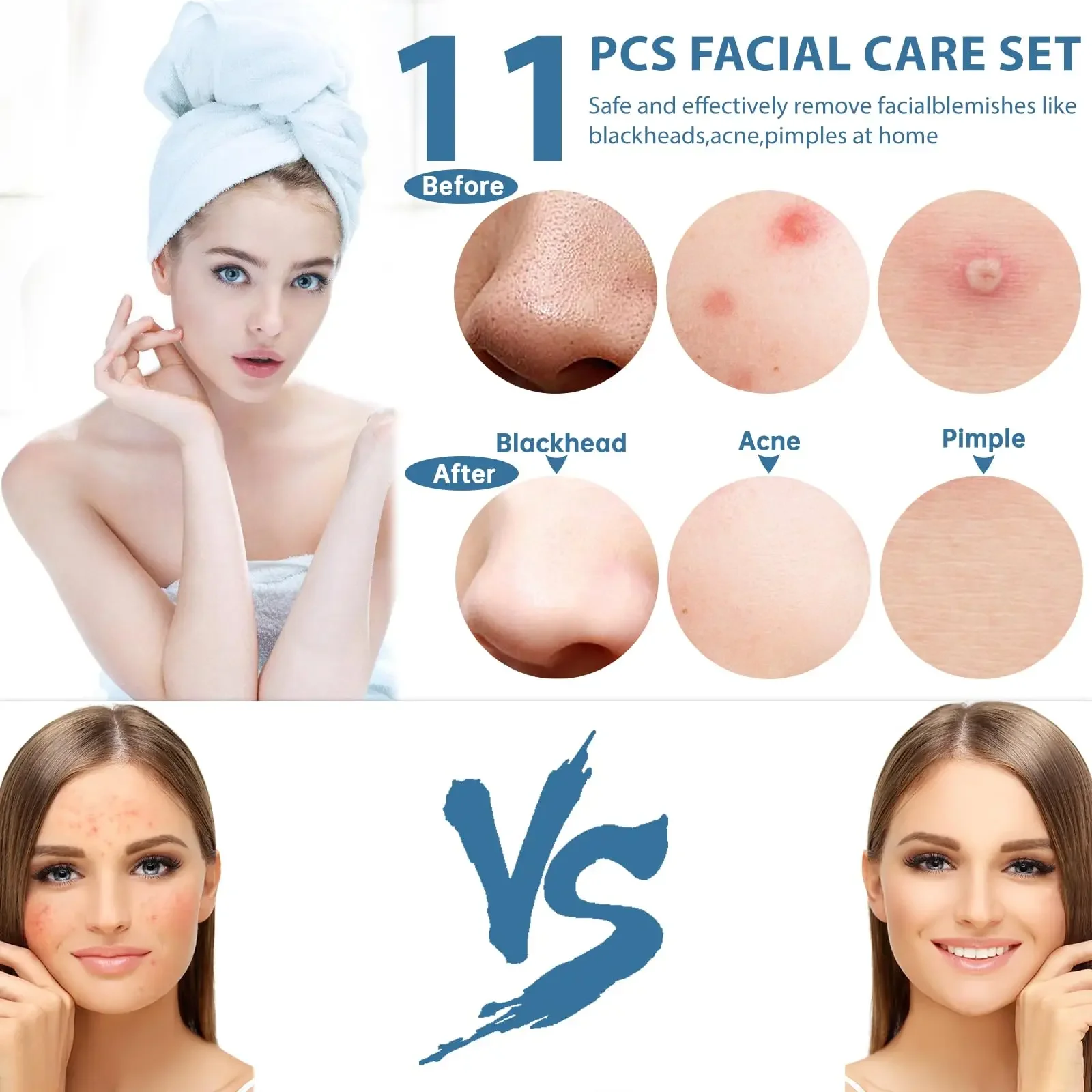 11Pc プロフェッショナルにきび面皰抽出ツールにきび除去にきびポッパーツールキットにきび白ニキビにきび除去鼻顔