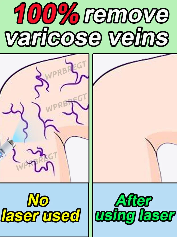 

Laser therapy for varicose veins, spider veins in the legs, treatment of sedentary behavior, blood circulation