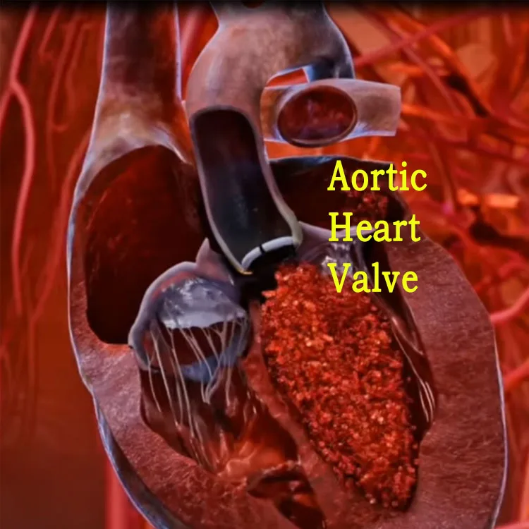 High Quality Mechanical Heart Valve Prosthesis Artificial Heart for Aortic/Mitral Replacement with Pyrolytic