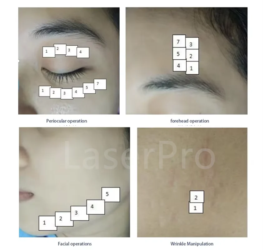 Vendita calda 3 in 1 macchina al plasma freddo fibroblasti al plasma freddo rimozione delle rughe rimozione della cicatrice anti-invecchiamento macchina per il rafforzamento della pelle