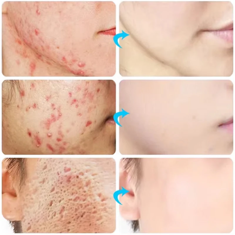 SADOER Máscara facial com controle de óleo, cuidados com a pele, limpeza dos poros, remoção de acne, reparação, clareamento, hidratante, ácido salicílico, máscara facial