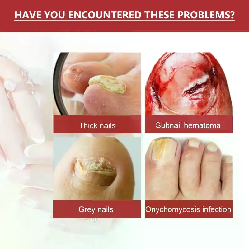 Fungal Nail Treatment Oil Foot Repair  Toe Nail Fungus Removal Gel Anti Infection Cream Fungal Nail Removal Paronychia