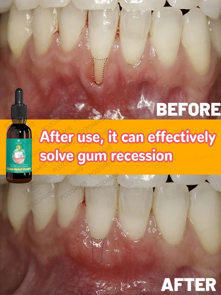 Protect gums and prevent tooth decay, effectively repair gums