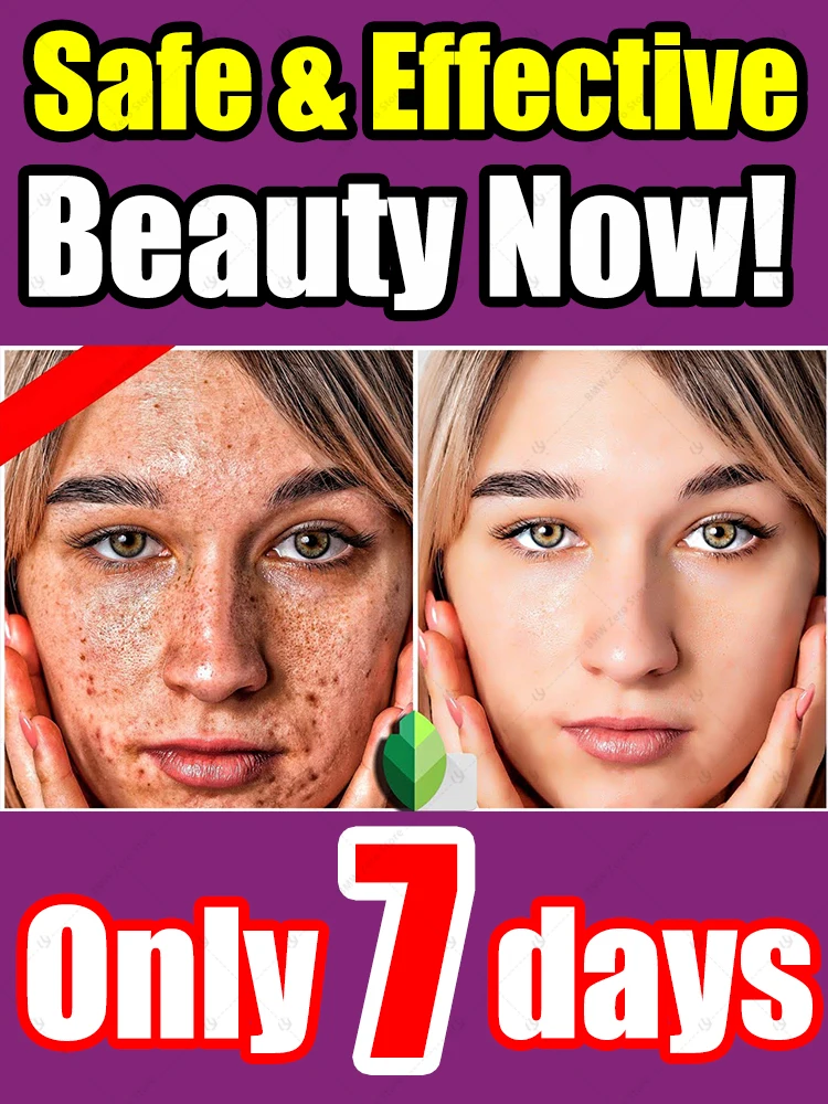 

Lighten Facial Freckles Melasma Dark Spots