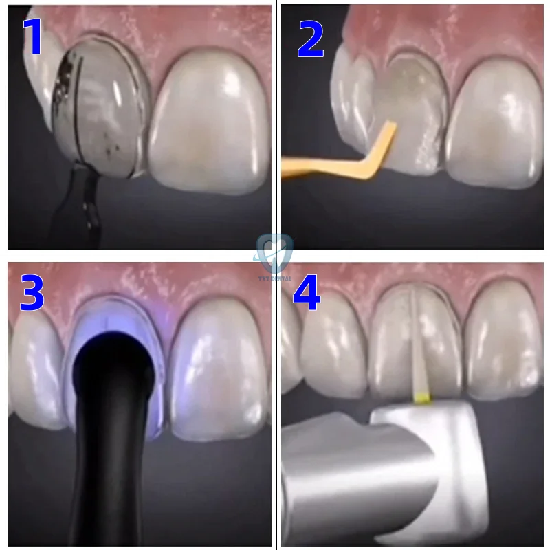 nico Kit de molde de chapa Dental, resina compuesta, curación ligera, relleno anterior, herramienta de blanqueamiento Dental, materiales de